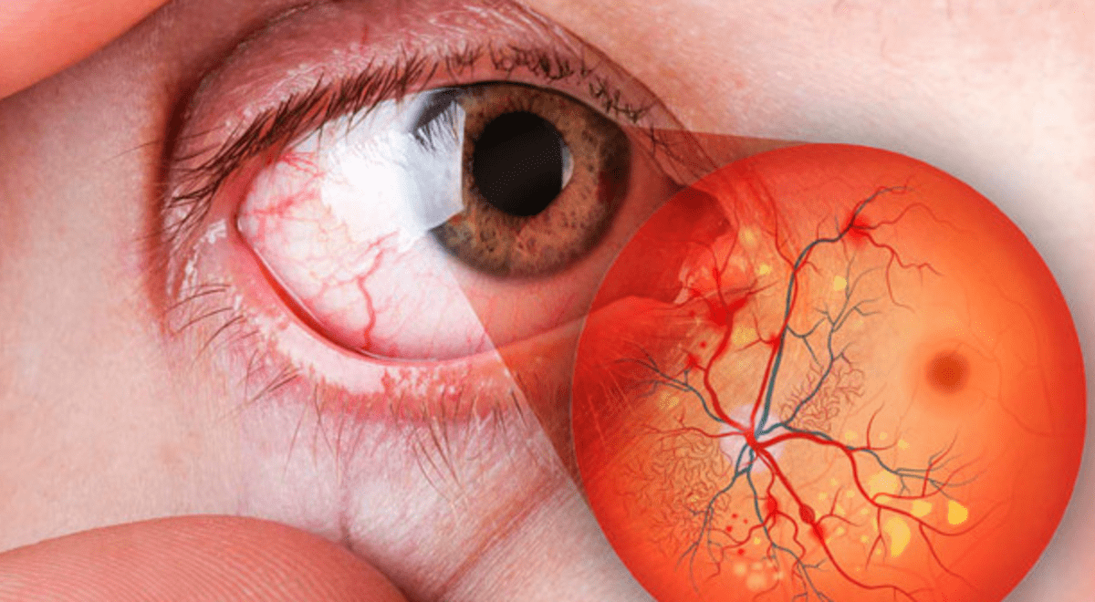 Ретинопатия диабетическая фото глаза