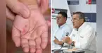 Alerta por incremento de casos del virus Coxsackie: ¿Quiénes corren más peligro y cómo se contagia?