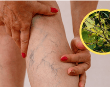 Esta hierba reduce varices y arañas vasculares según la UNAM, y está al alcance de todos Esta hierba reduce varices y arañas vasculares según la UNAM, y está al alcance de todos