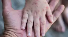 ¡Alerta epidemiológica! Reportan más de 30 casos de contagioso virus que ataca a niños en el PERÚ