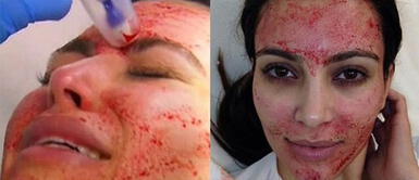 Tratamiento de belleza de Kim Kardashian "facial vampiro" ya se practica en el Perú. ¿Sabes en qué consiste? Tratamiento de belleza de Kim Kardashian "facial vampiro" ya se practica en el Perú. ¿Sabes en qué consiste?