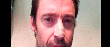 Cáncer de piel: conoce más sobre el mal que padece Hugh Jackman Cáncer de piel: conoce más sobre el mal que padece Hugh Jackman