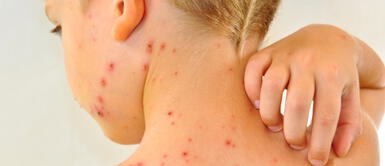 Cinco datos que no sabías de la varicela Cinco datos que no sabías de la varicela