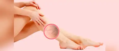 ¿Tienes várices en las piernas? Este remedio casero promete desaparecerlos en poco y es muy barato ¿Tienes várices en las piernas? Este remedio casero promete desaparecerlos en poco y es muy barato