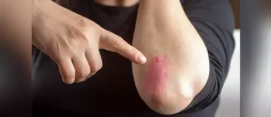 Psoriasis y los remedios caseros que te ayudarán a aliviar esta enfermedad Psoriasis y los remedios caseros que te ayudarán a aliviar esta enfermedad