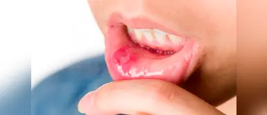 Cinco remedios caseros para combatir el afta bucal ¿Quieres combatir el afta bucal? Con estos remedios caseros lo lograrás