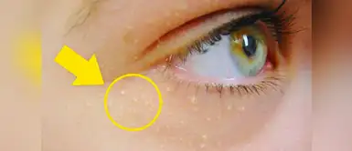 Un milium, un pequeño quiste epidérmico localizado en la región superficial de la piel ¿Tienes puntitos blancos en la piel? Descubre qué son, por qué aparecen y cómo eliminarlos