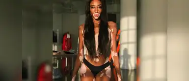 Winnie Harlow, a los cuatro años comenzó con los síntomas del vitiligo, razón por la cual fue víctima de acoso escolar. Winnie Harlow, a los cuatro años comenzó con los síntomas del vitiligo, razón por la cual fue víctima de acoso escolar.