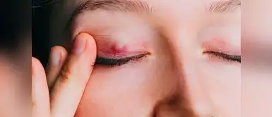 Con estos remedios caseros podrás eliminar el orzuelo efectivamente. ¿Tienes un orzuelo? Conoce estos siete remedios para eliminarlos efectivamente