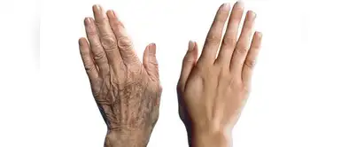 ¿Cómo evitar las manchas en las manos? Cuatro remedios caseros para eliminar las manchas de las manos