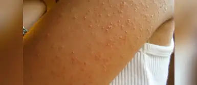 Remedios naturales para eliminar granitos Tres maneras naturales para eliminar los granitos en los brazos