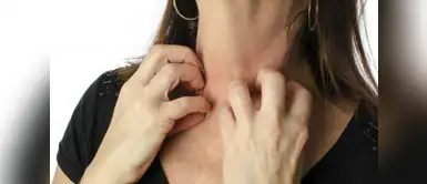 Sarpullido Sarpullido