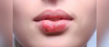 ¡No dejes de seguir estos consejos y evita estas molestosas lesiones! (Foto: Difusión) Remedios naturales para combatir los Herpes Bucales