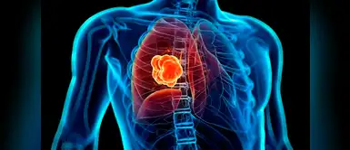 Cáncer de pulmón: tasa de mortalidad en mujeres aumentará en un 43% (Foto: Redes sociales) Científicos revelan que la tasa de mortalidad por cáncer de pulmón en mujeres aumentaría en un 43%