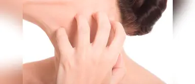 ¿Qué es dermografismo y cuál es la cura? (Foto: Redes Sociales) Dermografismo: ¿qué es y cómo se debe tratar?