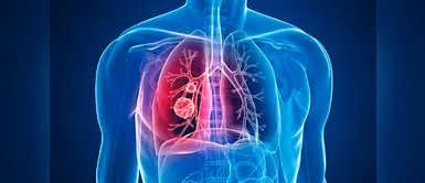 Cáncer de pulmón: cómo funciona la inmunoterapia (Foto: Nota de Prensa) Inmunoterapia: el tratamiento que puede alargar la vida de pacientes con cáncer de pulmón