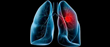 El cáncer de pulmón es una de las enfermedades que ha cobrado muchas vidas en el mundo. (Foto: Redes Sociales) Investigadores chinos descubren proteínas clave asociadas al cáncer de pulmón