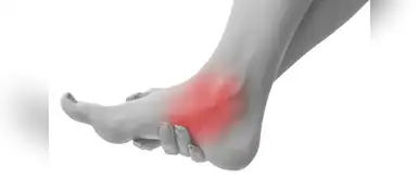 Es una de las lesiones más comunes que se produce al correr. (Foto: Redes Sociales) ¿Qué es la fascitis plantar y cómo podemos tratarlo?