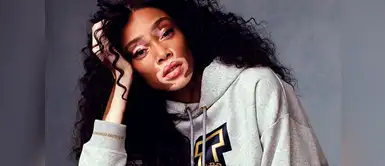 Conoce la enfermedad de la piel que padece la modelo Winnie Harlow. (Foto: Instagram/Winnie Harlow) Vitíligo, la enfermedad que afecta a la modelo Winnie Harlow