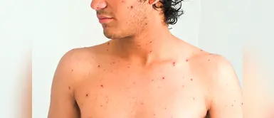 Vacuna a tu niño y previene a tiempo esta enfermedad. (Foto: Difusión) Alerta roja por caso confirmado de sarampión, en Cusco