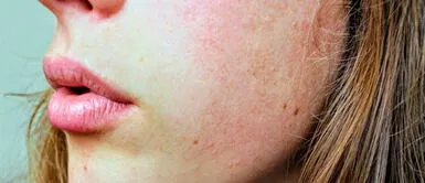 No descuides el cuidado de tu piel. Conoce cómo prevenir infecciones del rostro