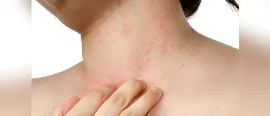 Recuerda consultar a un especialista si el malestar persiste. ¿Sarpullido? Combátelo de forma natural con estos remedios caseros