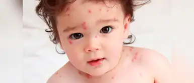 Casos de varicela podrían incrementar en primavera En primavera se incrementarían casos de varicela, según especialistas