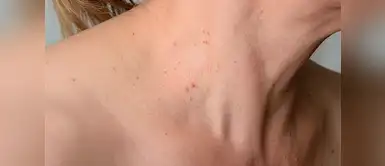 Con estos ingredientes podrás preparar el remedio casero para eliminar las verrugas Este remedio casero podría eliminar las verrugas de la piel