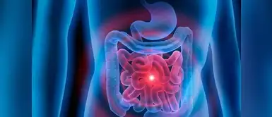Malabsorción intestinal multidisciplinar: todo lo que debes de saber de esta enfermedad ¿Qué es la malabsorción intestinal multidisciplinar? Entérate aquí