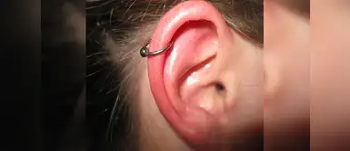 Infecciones en las orejas por los aretes ¿Por qué se infectan las orejas con algunos tipos de aretes?