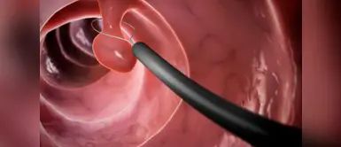 Pólipos uterinos tienen baja probabilidad de convertirse en cáncer Los pólipos uterinos tienen baja probabilidad de convertirse en cáncer