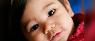 Datos de la varicela que quizá desconocías Siete datos que quizá no conocías sobre la varicela