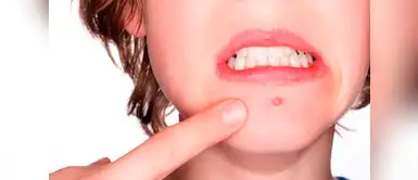 No dejes de seguir estos consejos para cuidar tu piel ante la presencia de granitos. (Foto: Instagram) Dime dónde te salen los granitos y te diré la causa