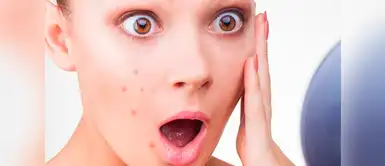 Tratamientos en consultorio para eliminar el acné Tratamientos en consultorio para eliminar el acné