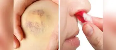 Conoce los síntomas de la leucemia y cómo detectarlo Conoce los síntomas de la leucemia y cómo detectarlo