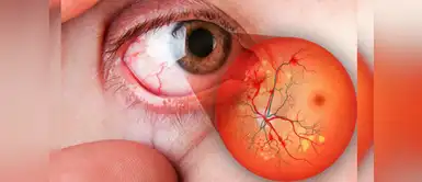 De esta manera la diabetes puede afectar tus ojos De esta manera la diabetes puede afectar tus ojos