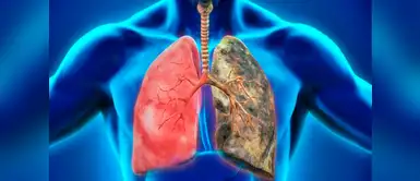 Epoc, enfermedad silenciosa que afecta el sistema respiratorio | OMS | pulmones Epoc, enfermedad silenciosa que afecta el sistema respiratorio