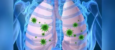 Aumentan a más de 38 mil los casos de pacientes con neumonía en el Perú Aumentan a más de 38 mil los casos de pacientes con neumonía en el Perú