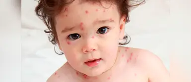 Varicela en el Perú: Más de 9 mil casos a nivel nacional | enfermedad | niños | vacunas Varicela en el Perú: Más de 9 mil casos a nivel nacional