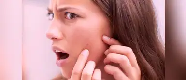 4 trucos caseros para quitar las manchas del acné 4 trucos caseros para quitar las manchas del acné