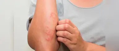 ¿Psoriasis? Estos remedios caseros son perfectos para tratar sus síntomas ¿Psoriasis? Estos remedios caseros son perfectos para tratar sus síntomas