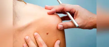 ¡Cuida tu salud! Sepa cómo reconocer un lunar cancerígeno ¡Cuida tu salud! Sepa cómo reconocer un lunar cancerígeno