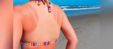 ¿Te arde la espalda? 4 remedios caseros para las quemaduras solares ¿Te arde la espalda? 4 remedios caseros para las quemaduras solares