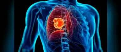 Estudiantes desarrollan sistema para detección de cáncer de pulmón Estudiantes desarrollan sistema para detección de cáncer de pulmón