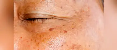 ¿Manchas oscuras en la piel? 5 tratamientos que sí funcionan ¿Manchas oscuras en la piel? 5 tratamientos que sí funcionan