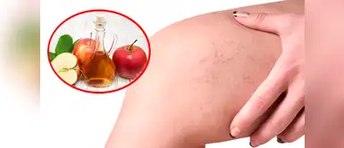 ¿Tienes arañas vasculares? Estos remedios caseros te ayudarán a eliminarlas ¿Tienes arañas vasculares? Estos remedios caseros te ayudarán a eliminarlas