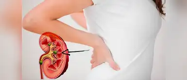 ¿Tienes entre 20 y 35 años? Eres más propensa a padecer cálculos renales ¿Tienes entre 20 y 35 años? Eres más propensa a padecer cálculos renales