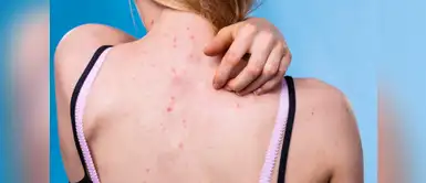 Cómo eliminar el acné de la espalda de forma natural Cómo eliminar el acné de la espalda de forma natural