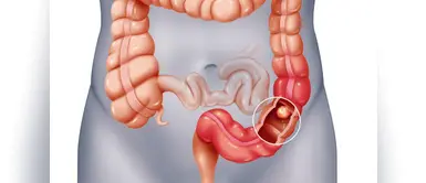 Cáncer colorrectal: Lo que debes saber acerca de los pólipos en el colon Cáncer colorrectal: Lo que debes saber acerca de los pólipos en el colon