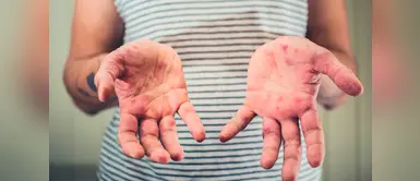 Herpes zóster: la enfermedad que se desarrolla después de tener varicela Herpes zóster: la enfermedad que se desarrolla después de tener varicela